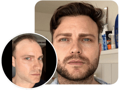 patient elithair s'étant fait greffer 3700 greffons avec la technique fue