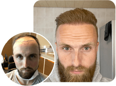 patient elithair s'étant fait greffer 4700 greffons avec la technique fue