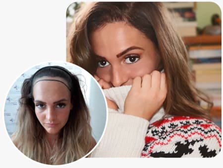 patiente elithair s'étant fait greffer 2200 greffons avec la greffe de cheveux pour femme