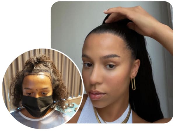 patiente elithair s'étant fait greffer 2700 greffons avec la greffe de cheveux pour femme