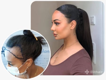 patiente elithair s'étant fait greffer 3200 greffons avec la greffe de cheveux pour femme