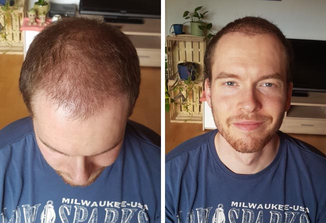 Image 2 mois après greffe de cheveux DHI 3500 greffons Lukas jaeger