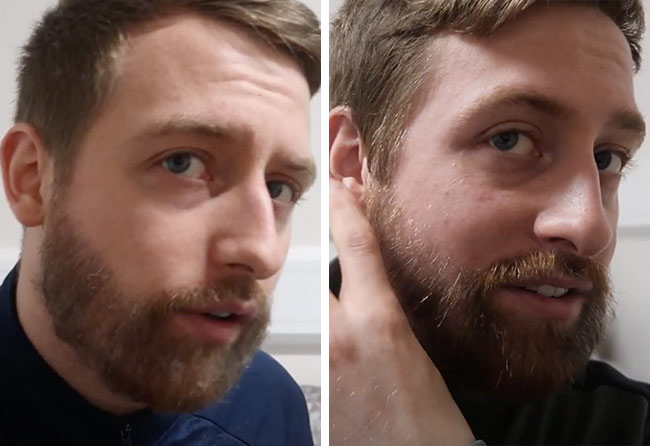 Image 4 mois après implant de barbe saphir 4200 greffons Jay Jones