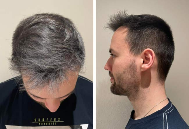 Image 5 mois après greffe de cheveux saphir 2700 greffons Alexander Volwerk