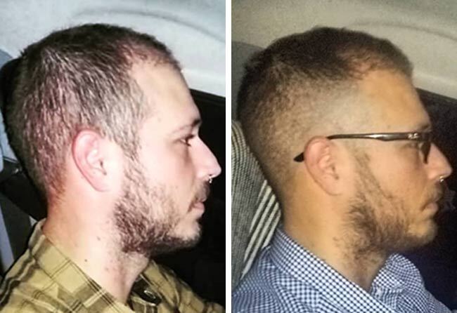 Image 5 mois après greffe de cheveux saphir 4200 greffons Jorge Diaz