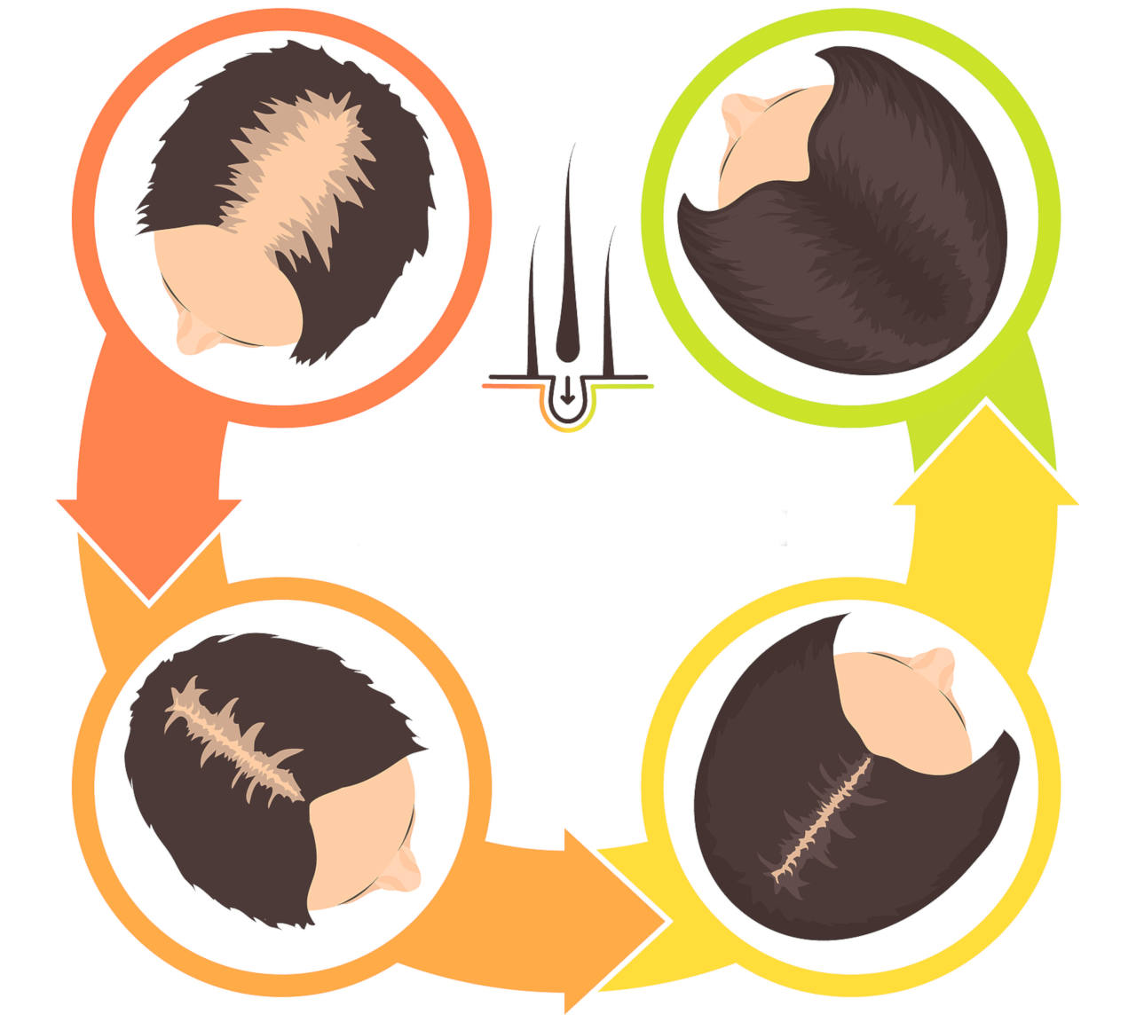 Illustration des causes de perte de cheveux après une greffe de cheveux