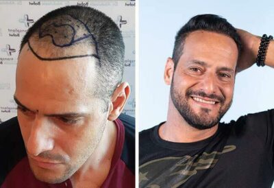 Photo avant et après la greffe de cheveux saphir avec 3500 greffons de Rawderson Amaral