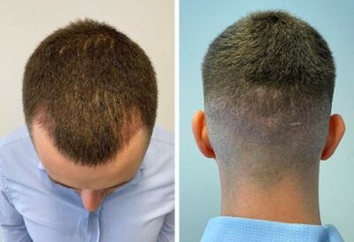 Photo prise 4 semaines après la greffe de cheveux dhi avec 3140 greffons du patient Cilian White