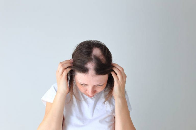 femme atteinte d'une pelade avec des taches chauves sur sa tête