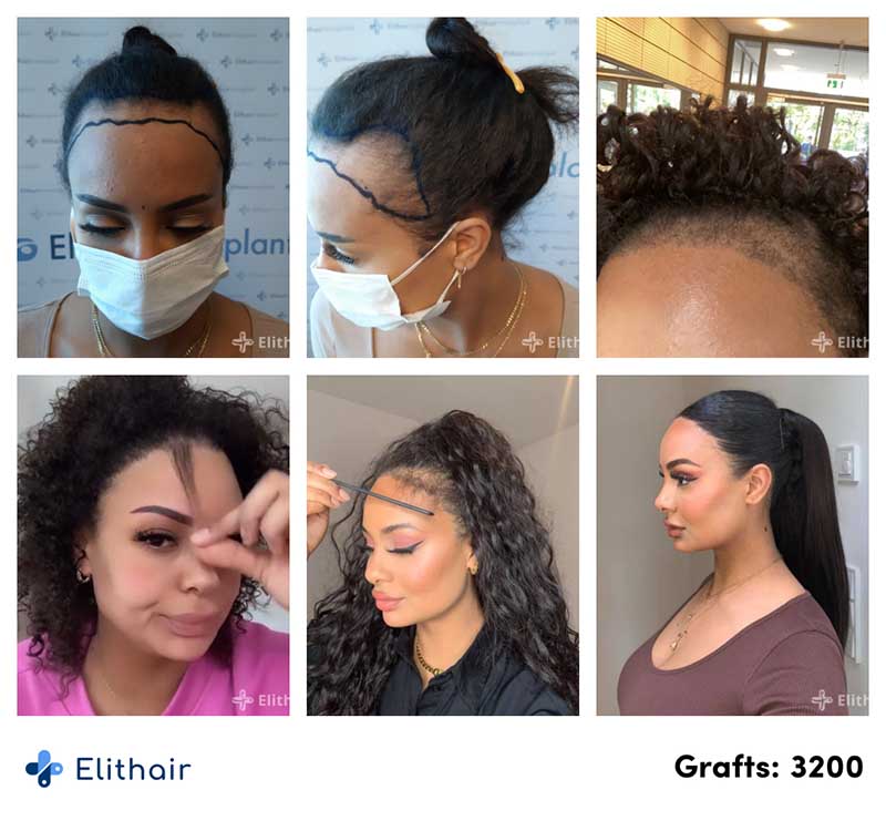 photos avant aprés de la greffe de cheveux pour femme de la patiente Jahy effectuée avec 3200 greffons à la clinique Elithair