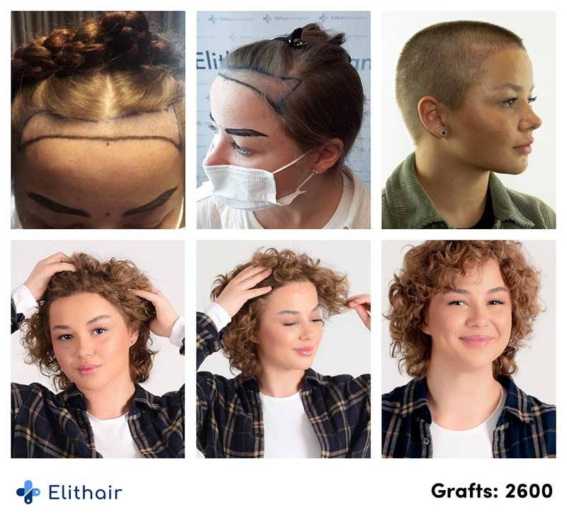 photos avant aprés de la greffe de cheveux pour femme de la patiente Lilianna effectuée avec 2600 greffons à la clinique Elithair