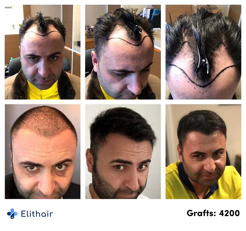 Image avant après greffe de cheveux saphir Murat K. Elithair