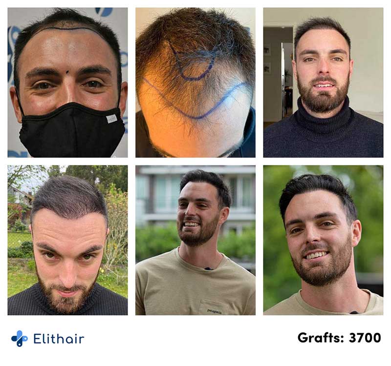 photos avant aprés de la greffe de cheveux DHI avec 3700 greffons effectuée par le patient Sébastien à Elithair