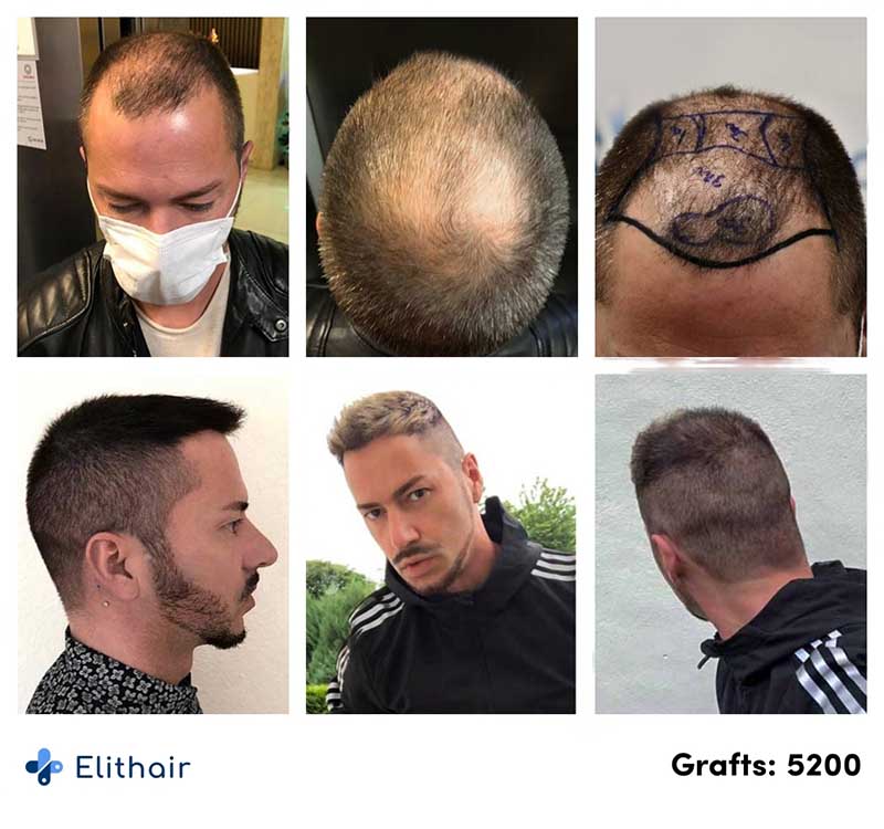 patient-elithair-avant-apres-greffe-de-cheveux-fue-dhi-5200-greffons-andre-o
