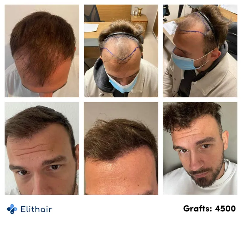 Images de Orkan, un patient Elithair, montrant l'évolution de sa greffe de cheveux effectuée avec 4500 greffons