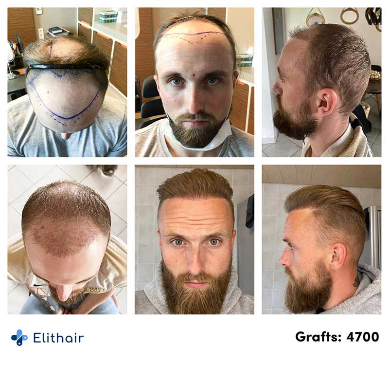 Images de Frederik, un patient Elithair, montrant l'évolution de sa greffe de cheveux effectuée avec 4700 greffons