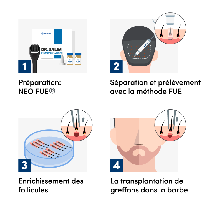 infographie montrant les étapes d'une greffe de barbe