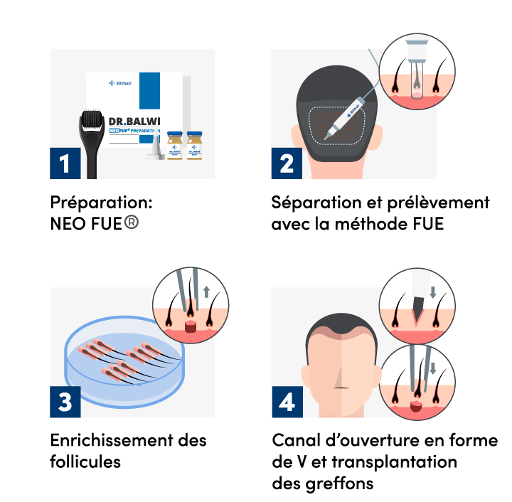 schema-greffe-de-cheveux-percutanée-Elithair