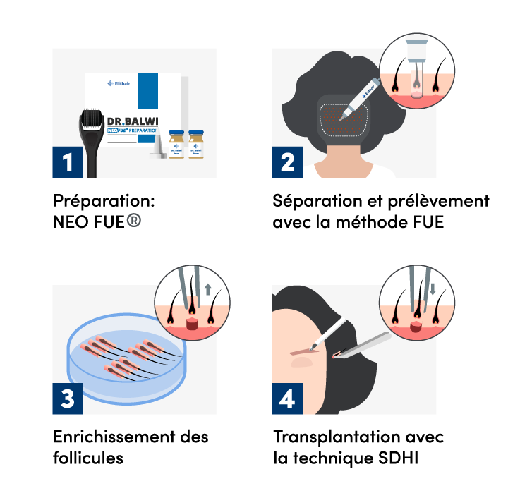 Illustration en 4 étapes de la procédure de l'implant de sourcils