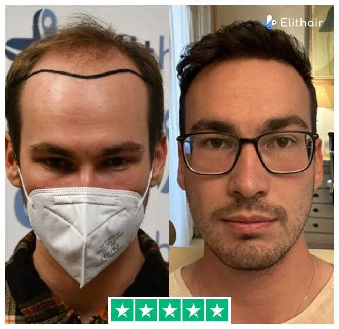 La photo montre Marcel, un patient Elithair, avant et après sa transplantation capillaire de 4700 greffons.