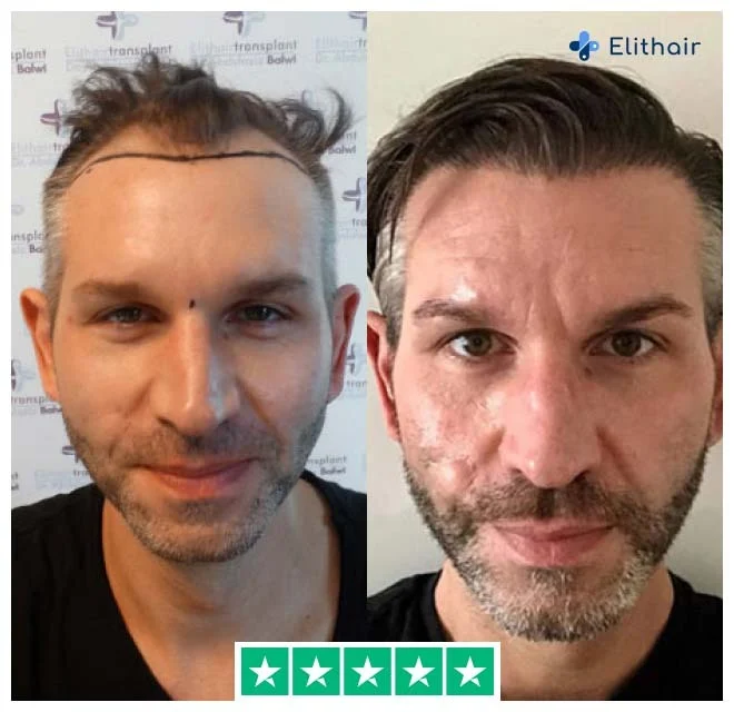 La photo montre Thomas, un patient Elithair, avant et après sa transplantation capillaire de 4250 greffons.