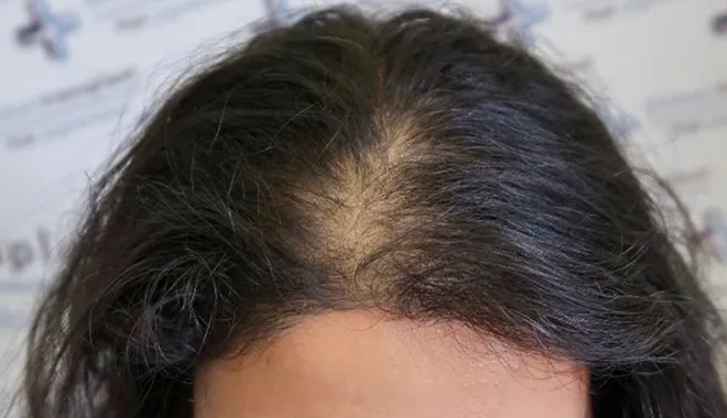 Amincissement des cheveux chez une patiente Elithair