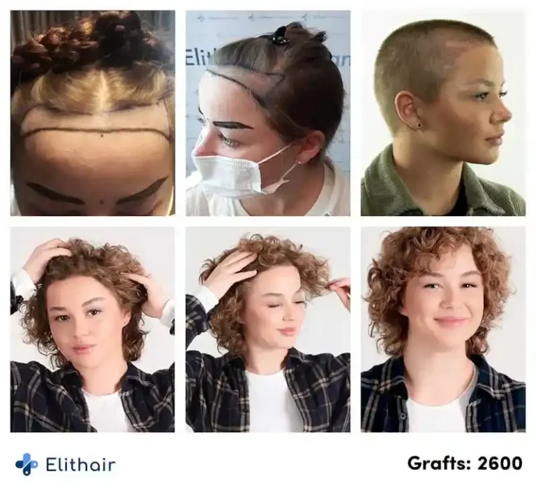 Résultats de l'évolution d'une greffe de cheveux chez une patiente nommée Lilianna, avec 2600 greffons implantés. L'image montre les progrès avant et après la greffe, illustrant la densité et la repousse des cheveux chez cette patiente féminine