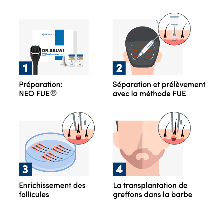 Schéma des étapes de la greffe de barbe chez Elithair.