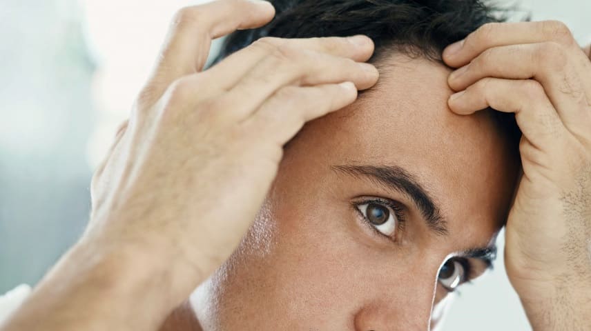 La calvitie peut commencer chez certains hommes à à partir de 20 ans