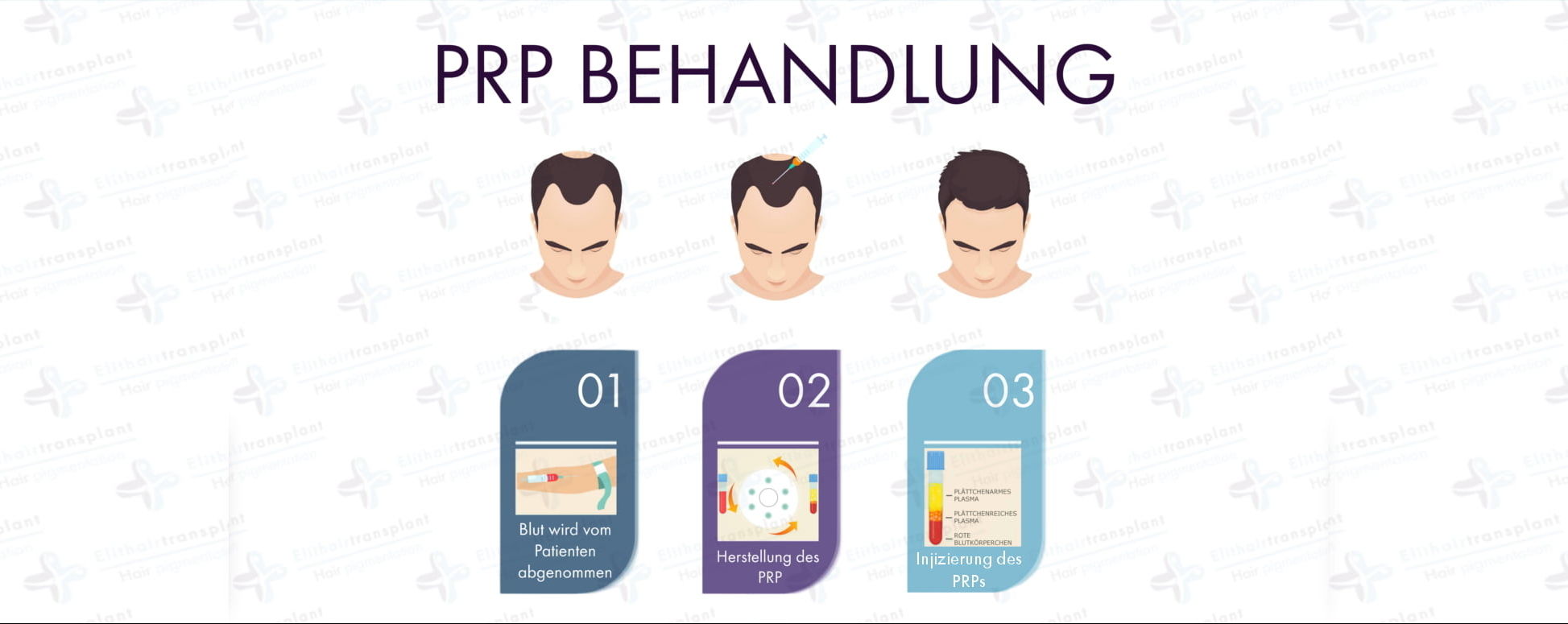 Alternativen der Haartransplantation PRP Behandlung
