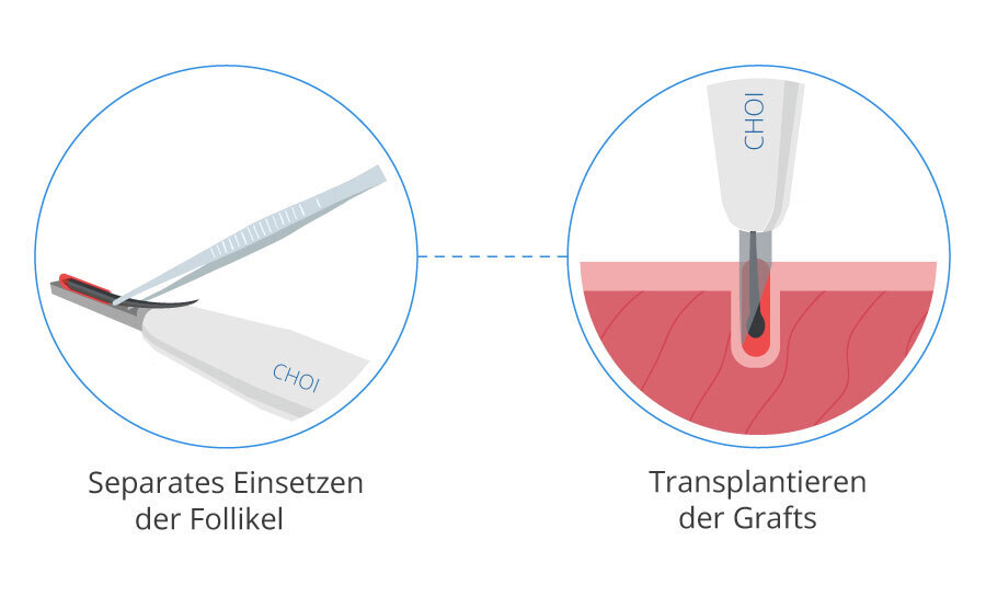 Infografik für die DHI Technik als Haartransplantation Methode