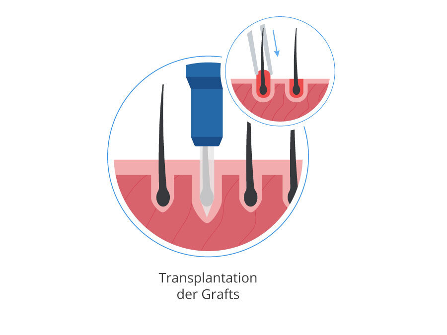 Infografik für die Saphir Technik als Haartransplantation Methode