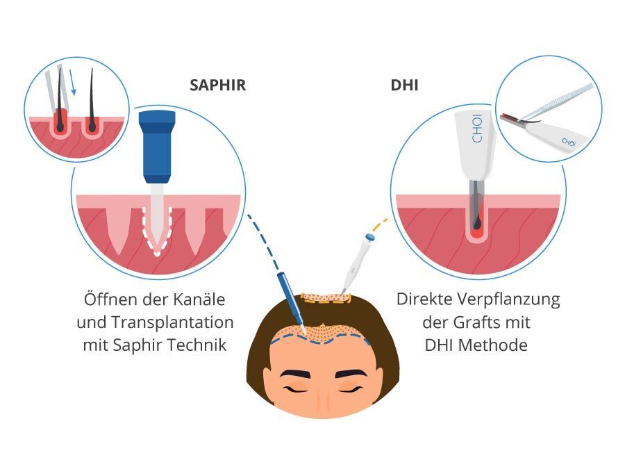 Infografik für die SDHI Technik als Haartransplantation Methode