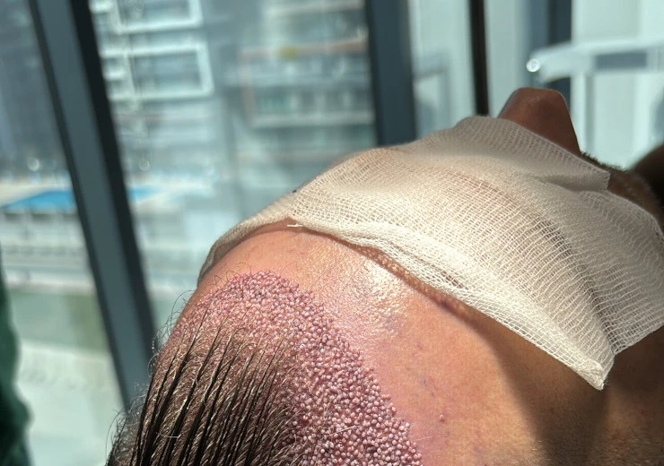 Patient nach einer Haartransplantation