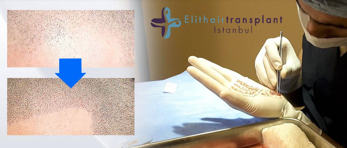Minimal invasive Haartransplantation
