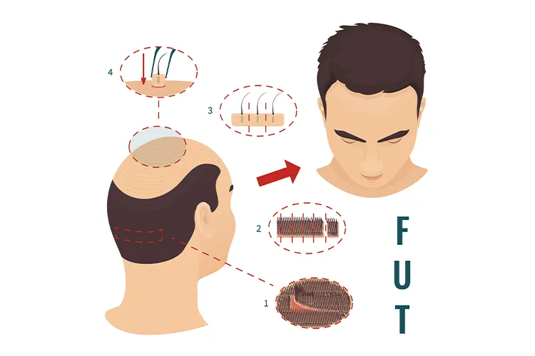 Die FUT-Transplantation wird einfach auf dem Bild erklärt und dargestellt