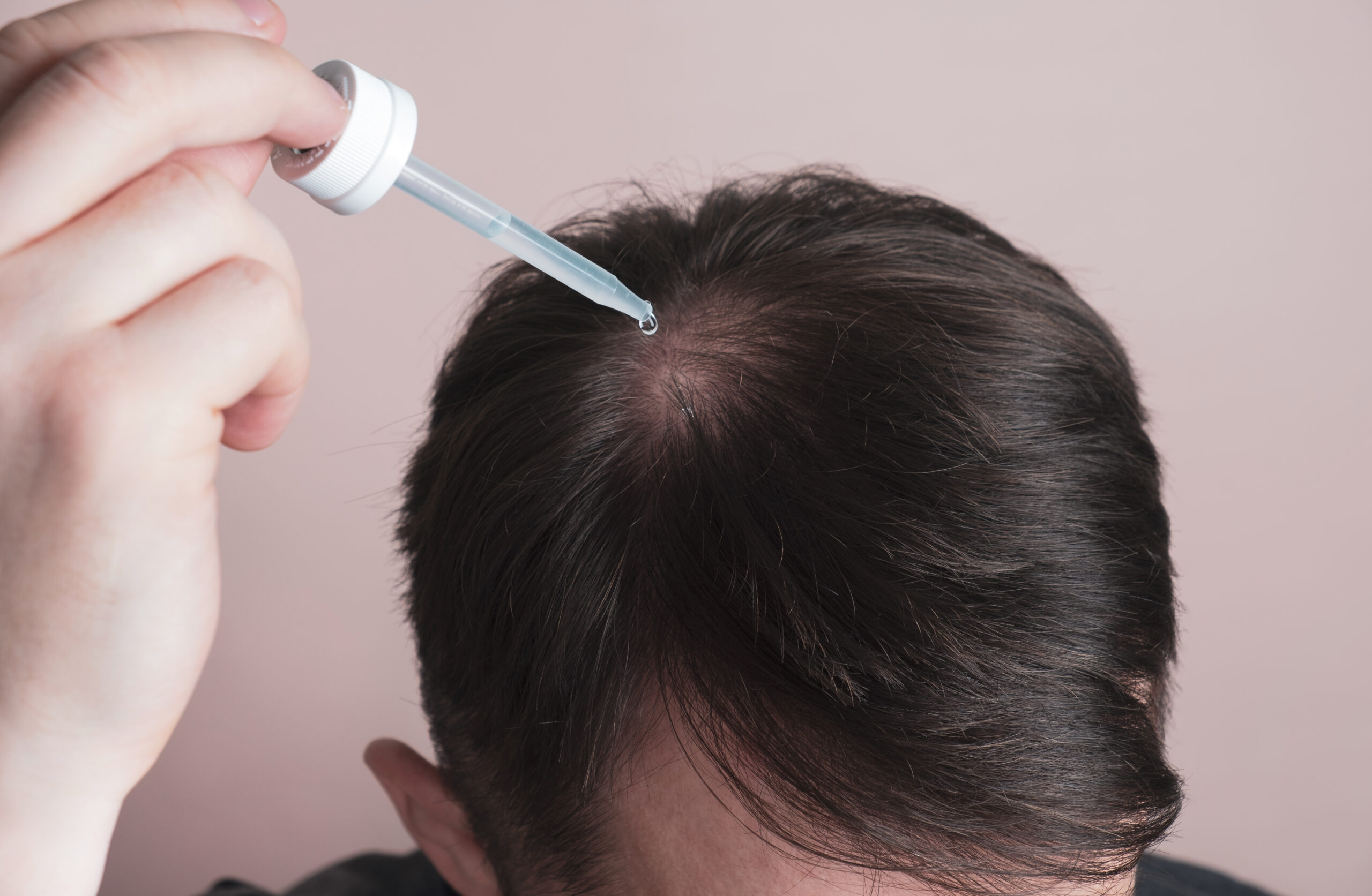 Mann wendet Minoxidil gegen Haarausfall an