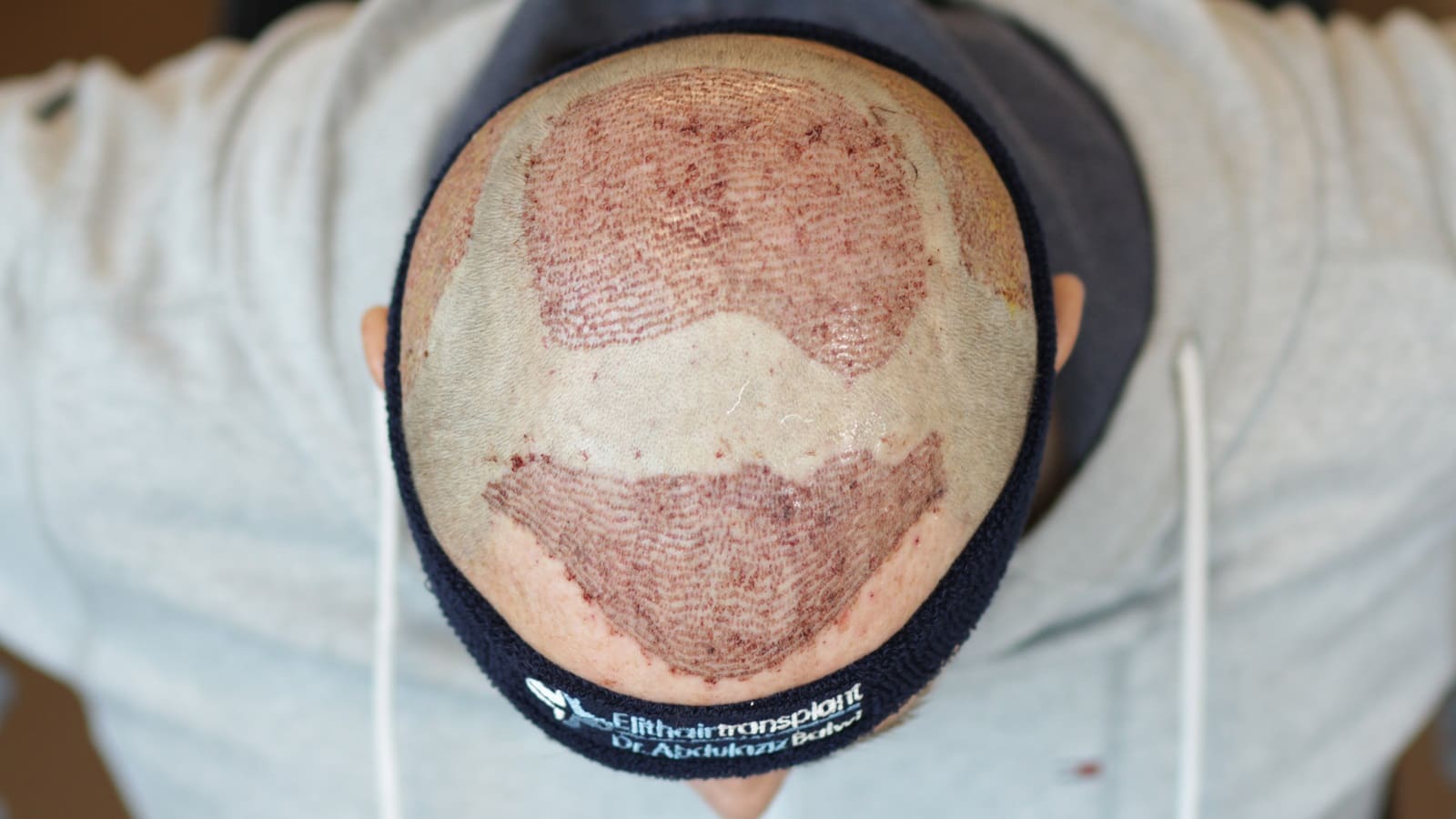 Eine Haartransplantation nach der FUE Methode