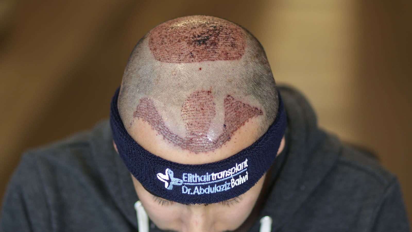 Haartransplantation Tonsur