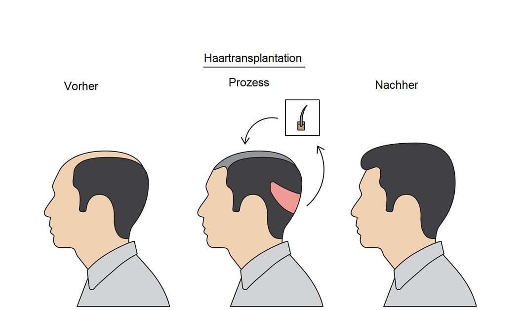 Vor- und Nachteile der Haartransplantation Methoden