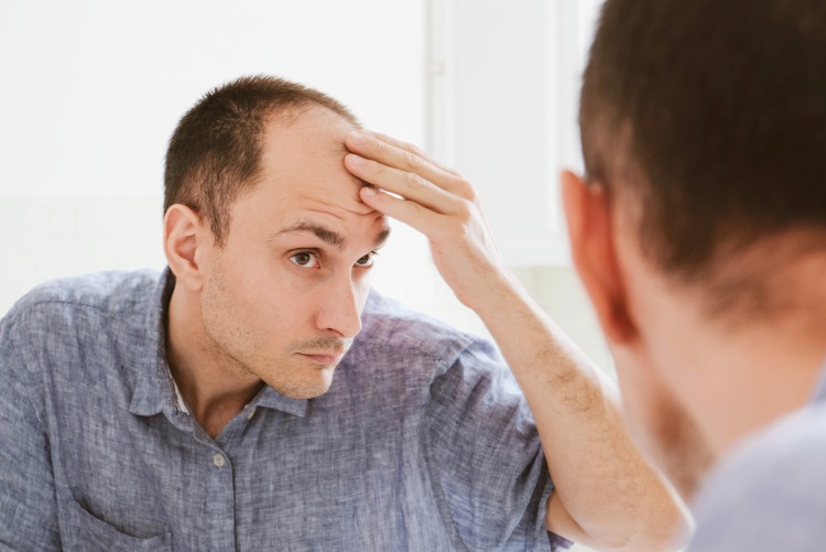 Mann mit androgenetische Alopezie vor dem Spiegel fasst sich an seine kahle Stirn