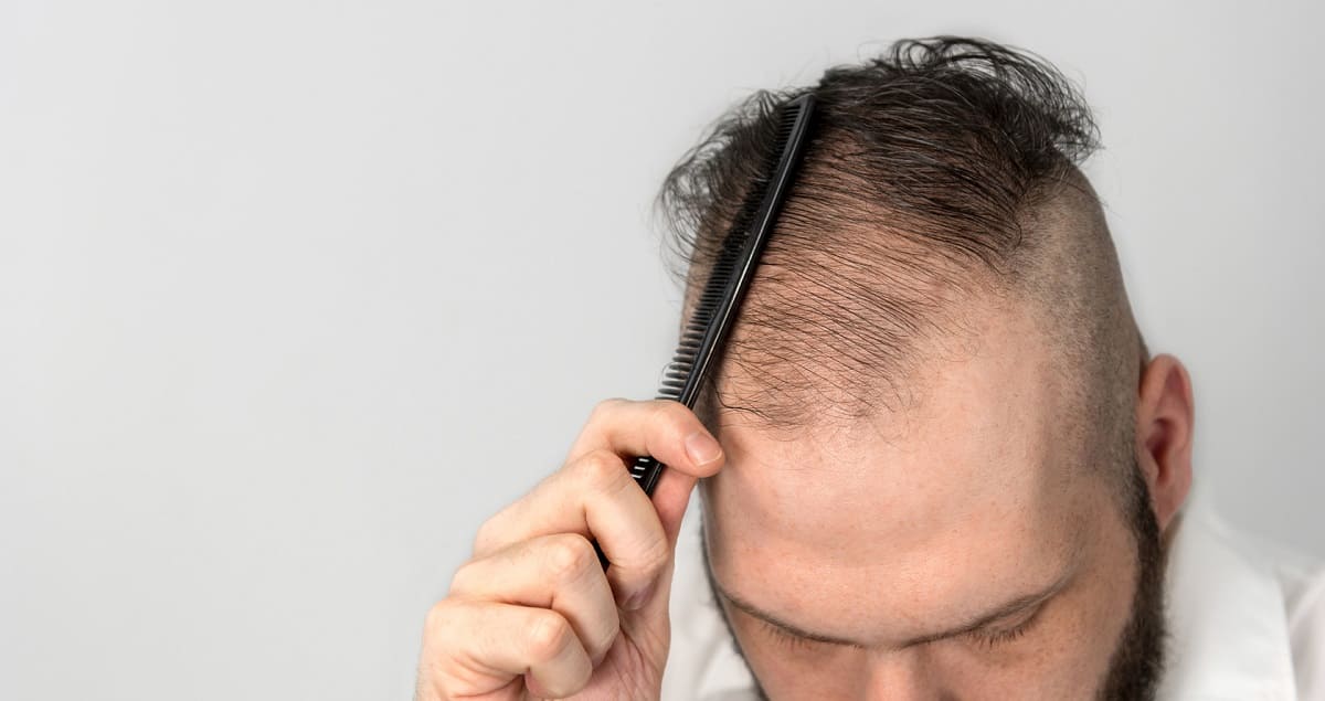 Autoimmunerkrankung Haarausfall – Was kann man dagegen tun