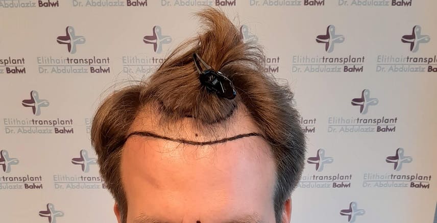 Alopezie Leitlinie Haarline gezeichnet Elithairtransplant