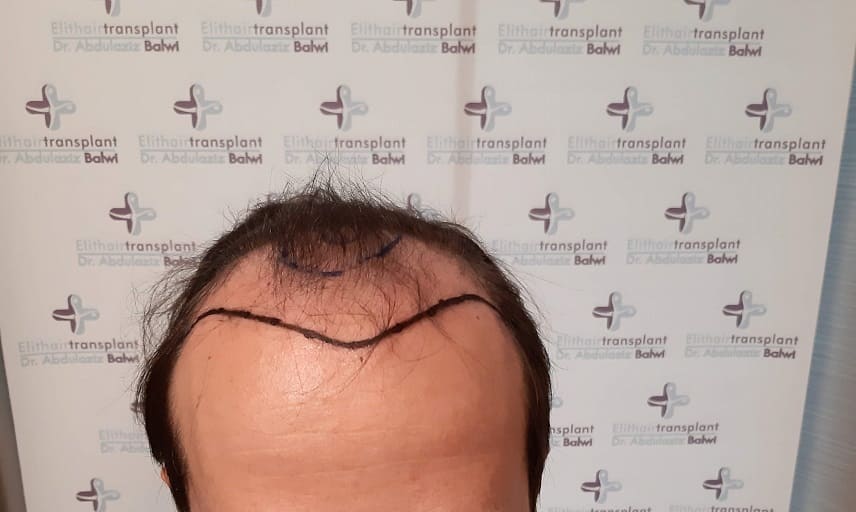 Frontaler Haarausfall