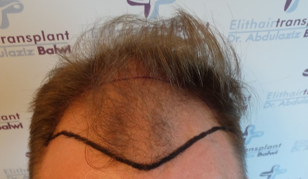 Haarausfall durch Essstörung