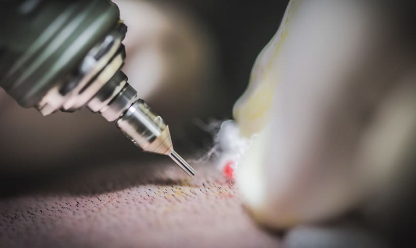 Hohlnadel Haartransplantation