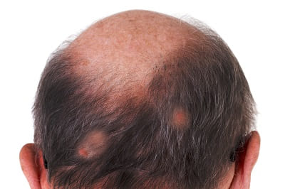 Kopfhauterkrankung mit Haarausfall Lichen Ruber