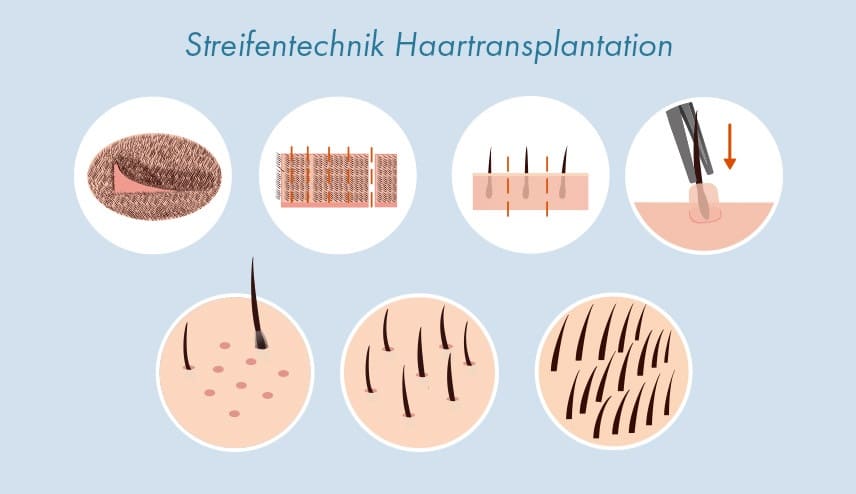 Streifentechnik Haartransplantation FUT Methode