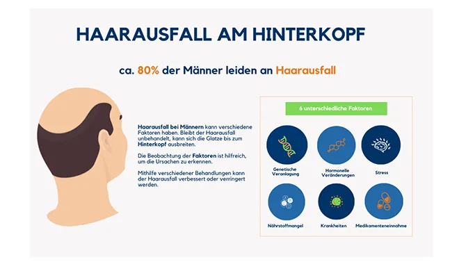 Infografik über die Arten von Haarausfall am Hinterkopf bei Männern von der Klinik Elithair