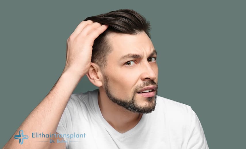 Haarausfall an den Schläfen beim Mann
